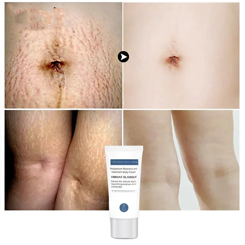 Vibrant Glamour Stretch Mark Repair Cream for Postpartum